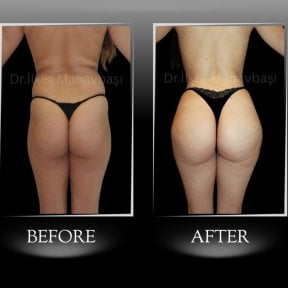 Vorher-nachher-Ergebnis Brazilian Butt Lift in Dr. Ilker Manavbasi's Clinic, verbesserte Kurven