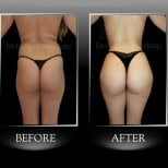 Vorher-nachher-Ergebnis Brazilian Butt Lift in Dr. Ilker Manavbasi's Clinic, verbesserte Kurven