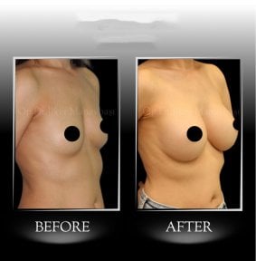 نتائج تكبير الثدي قبل وبعد في عيادة د. إيلكر مانافباشي، صدر أكثر امتلاءً