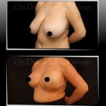 Before and after breast reduction results at Dr. Ilker Manavbasi's Clinic, improved contour