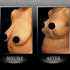 Before and after breast reduction results at Dr. Ilker Manavbasi's Clinic, improved contour