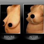 Before and after breast reduction results at Dr. Ilker Manavbasi's Clinic, improved contour