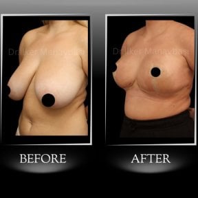 Before and after breast reduction results at Dr. Ilker Manavbasi's Clinic, improved contour