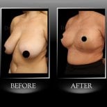 Before and after breast reduction results at Dr. Ilker Manavbasi's Clinic, improved contour