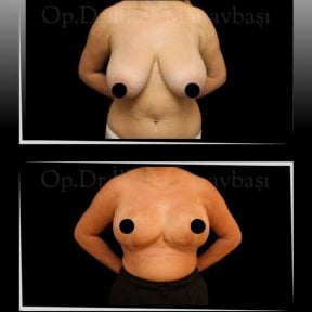 Before and after breast reduction results at Dr. Ilker Manavbasi's Clinic, improved contour