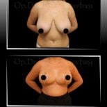 Before and after breast reduction results at Dr. Ilker Manavbasi's Clinic, improved contour