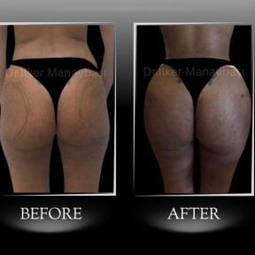 Vorher-nachher-Ergebnisse Brazilian Butt Lift bei Dr. Ilker Manavbasi's Clinic, betonte Kurven