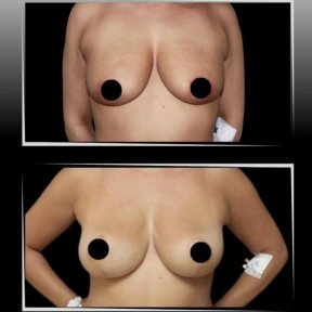 Vorher-nachher-Ergebnis Bruststraffung bei Dr. Ilker Manavbasi's Clinic, verbesserte Form