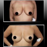 Vorher-nachher-Ergebnis Bruststraffung bei Dr. Ilker Manavbasi's Clinic, verbesserte Form