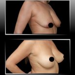 Vorher-nachher-Ergebnis Bruststraffung in Dr. Ilker Manavbasi's Klinik, verbesserte Kontur