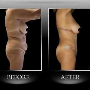 Vorher-nachher-Ergebnis Backlift in Dr. Ilker Manavbasi's Klinik, verbesserte Körperkontur