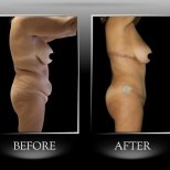 Vorher-nachher-Ergebnis Backlift in Dr. Ilker Manavbasi's Klinik, verbesserte Körperkontur