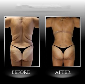 Backlift Vorher-Nachher-Ergebnisse in Dr. Ilker Manavbasis Klinik, verbesserte Rückenform