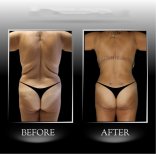 Backlift Vorher-Nachher-Ergebnisse in Dr. Ilker Manavbasis Klinik, verbesserte Rückenform