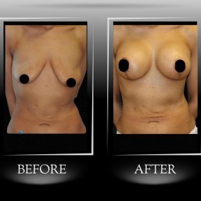 До та після імплантації грудей з підтяжкою у клініці Dr. Ilker Manavbasi, покращений контур