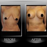 До та після імплантації грудей з підтяжкою у клініці Dr. Ilker Manavbasi, покращений контур