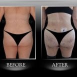 Vorher-nachher-Ergebnis Brazilian Butt Lift bei Dr. Ilker Manavbasi's Clinic, verbesserte Kurven
