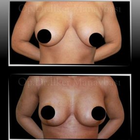 Vorher-nachher-Ergebnis Bruststraffung in Dr. Ilker Manavbasi's Klinik, verbesserte Kontur