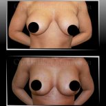 Vorher-nachher-Ergebnis Bruststraffung in Dr. Ilker Manavbasi's Klinik, verbesserte Kontur