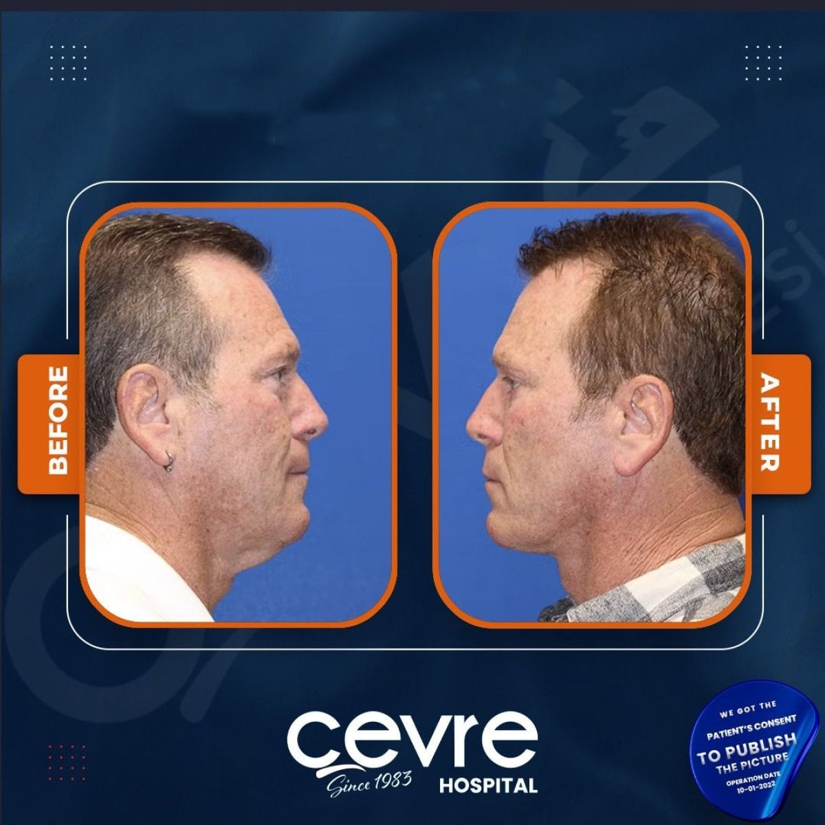 Resultados de lifting facial antes y después en Adem and Havva Medical Center, rejuvenecimiento visible