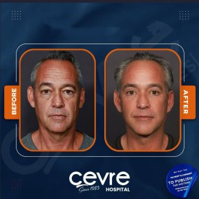 Facelift Vorher-Nachher-Ergebnisse in der Cevre Hospital, sichtbare Verjüngung bei Mann