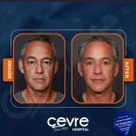 Facelift Vorher-Nachher-Ergebnisse in der Cevre Hospital, sichtbare Verjüngung bei Mann