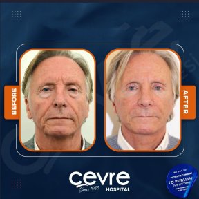 Facelift Vorher-Nachher-Ergebnisse bei Adem and Havva Medical Center, sichtbare Verjüngung