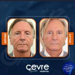 Facelift Vorher-Nachher-Ergebnisse bei Adem and Havva Medical Center, sichtbare Verjüngung