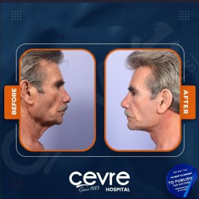 Facelift Vorher-Nachher-Ergebnisse bei Adem and Havva Medical Center, sichtbare Verjüngung