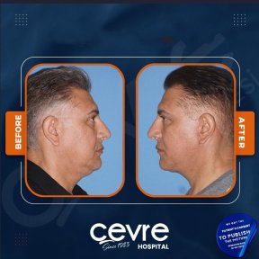 Facelift Vorher-Nachher-Ergebnisse bei Adem and Havva Medical Center, sichtbare Verjüngung