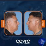 Facelift Vorher-Nachher-Ergebnisse bei Adem and Havva Medical Center, sichtbare Verjüngung