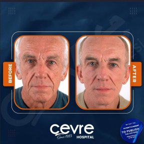 Facelift Vorher-Nachher-Ergebnisse bei Adem and Havva Medical Center, sichtbare Verjüngung