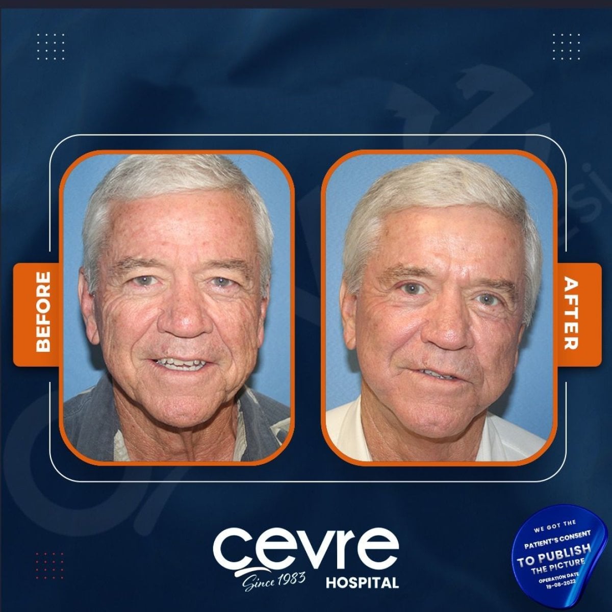 نتائج شد الوجه قبل وبعد في Adem and Havva Medical Center، تجديد شباب الوجه
