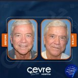 Facelift Vorher-Nachher-Ergebnisse bei Adem and Havva Medical Center, sichtbare Verjüngung