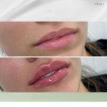 Vorher-nachher-Ergebnis Lippenfiller bei Plenary Wellness, mehr Volumen und Kontur