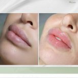 Vorher-nachher-Ergebnis Lippenfiller bei Plenary Wellness, mehr Volumen und Kontur