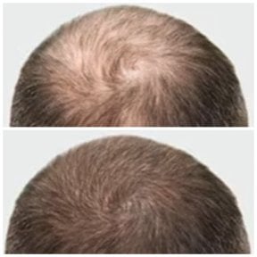 Результаты пересадки волос в Somchai Clinic: до и после, улучшенная густота на макушке