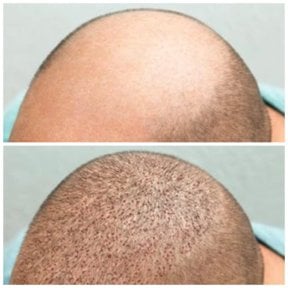 Результаты пересадки волос до и после в клинике Somchai, видимое увеличение густоты