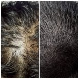 Результаты пересадки волос до и после в клинике Somchai – заметное увеличение густоты