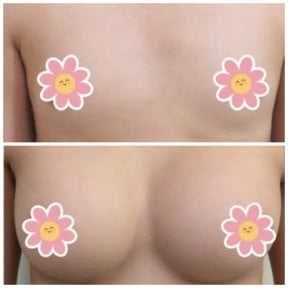 نتائج قبل وبعد تكبير الثدي في عيادة سومشاي، زيادة حجم الثدي