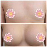 نتائج قبل وبعد تكبير الثدي في عيادة سومشاي، زيادة حجم الثدي