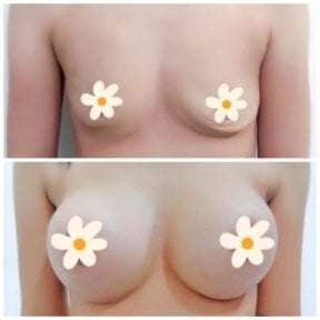 Before and after breast augmentation results at Somchai Clinic – enhanced breast volume
