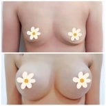 Before and after breast augmentation results at Somchai Clinic – enhanced breast volume
