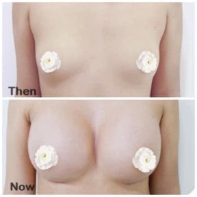 Before and after breast augmentation results at Somchai Clinic, enhanced breast volume