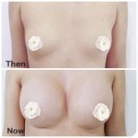 Before and after breast augmentation results at Somchai Clinic, enhanced breast volume