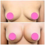 Before and after breast augmentation results at Somchai Clinic, enhanced breast volume