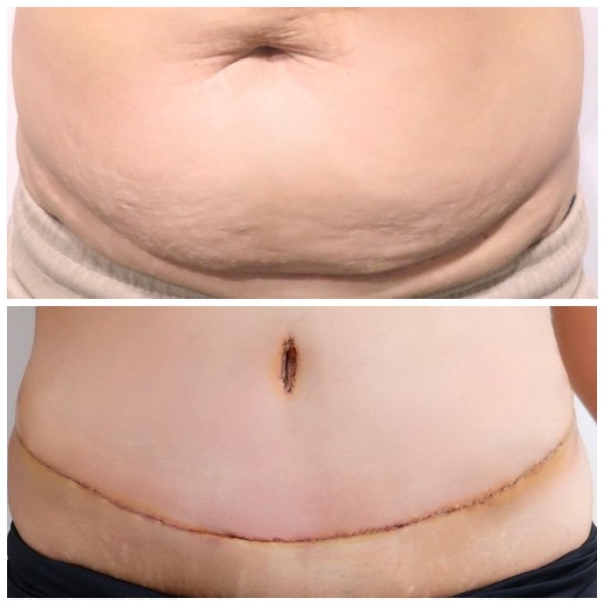 Resultados de abdominoplastia antes y después en Somchai Clinic – contorno abdominal mejorado