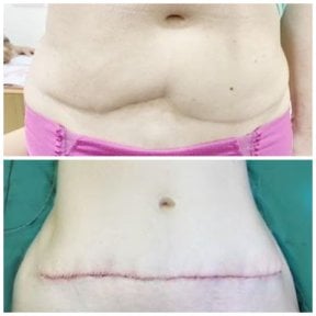 Before and after tummy tuck results at Somchai Clinic – improved abdominal contour