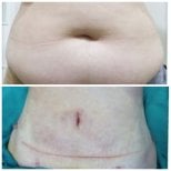 Before and after tummy tuck results at Somchai Clinic – visible abdominal contour improvement
