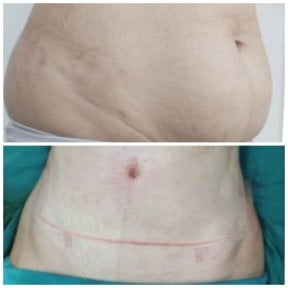 Before and after tummy tuck results at Somchai Clinic – improved abdominal contour